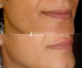 Ingrandimento labbra con grasso (lipofilling) - Foto del prima - Clinica Estetica Europa