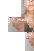 Liposuzione - Foto del prima - Dott. Massimo Re - Chirurgo plastico ed estetico