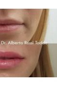 Aumento labbra - Foto del prima - Dott. Alberto Rossi Todde