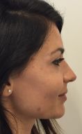 Rinoplastica secondaria - Settorinoplasticaterziaria. Riduzione volumetrica di dorso e punta nasale..