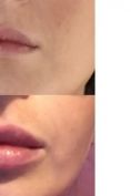 Aumento labbra - Foto del prima - Dott. Leonardo Michele Ioppolo Md