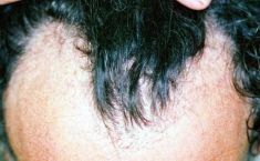PANACEA HAIR CLINIC - Foto del prima - PANACEA HAIR CLINIC