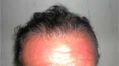 Trapianto capelli - Foto del prima - Dott. Salvatore Marrocco