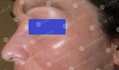 Procedure laser in dermatologia estetica  - Foto del prima - Dott. Fabio Chemello CENTRO MEDICO GENESY