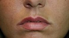 Aumento labbra - Foto del prima - Dott. Sergio Delfino M.D.