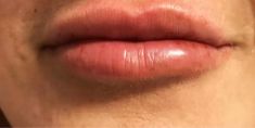 Aumento labbra - Foto del prima - Dott. Alfio Scalisi - 4 Spa Medical Clinic