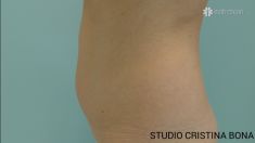 Liposuzione - Foto del prima - Dott.ssa Cristina Bona