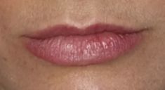 Aumento labbra - Filler labbra con aumento definizione e risultato naturale.