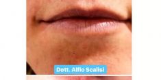 Aumento labbra - Foto del prima - Dott. Alfio Scalisi - 4 Spa Medical Clinic