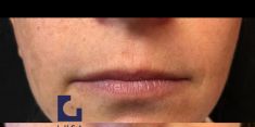 Aumento labbra - Foto del prima - Dott. Luca Grassetti