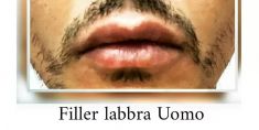 Aumento labbra - Foto del prima - Dott.ssa Elvira Gisella Cotilli