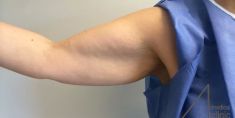 Lifting delle braccia - Foto del prima - Dott. Alfio Scalisi - 4 Spa Medical Clinic