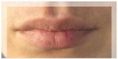 Aumento labbra - Foto del prima - Dott.ssa Elvira Gisella Cotilli