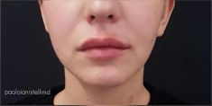 Aumento labbra - Foto del prima - Dott. Paolo Iannitelli