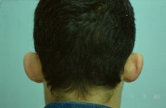 Operazione orecchie (Otoplastica) - Foto del prima - Prof. Franco MIGLIORI