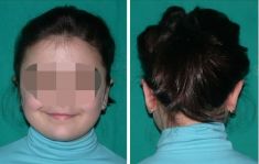Operazione orecchie (Otoplastica) - Foto del prima - Dott. Andrea La Padula M.D.