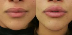 Aumento labbra - Foto del prima - Dott. Stefano Salluce