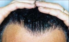 PANACEA HAIR CLINIC - Foto del prima - PANACEA HAIR CLINIC