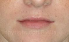 Aumento labbra - Foto del prima - Dott. Francesco Alia