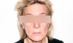 Radiofrequenza estetica – apparecchiature Aluma, Accent, TriPollar, Spa RF, Re-Age - Foto del prima - Dott. Naser Jabbarpour