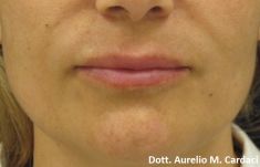 Dott. Aurelio M. Cardaci - Impianto Permalip 60x5 labbro sup e 55x5 labbro inf.
Post 3 mesi. Si noti la morbidezza della protesi nella mimica.
