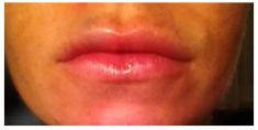Aumento labbra - Foto del prima - Dott.ssa Francesca Mazzeo