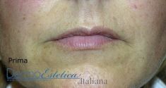 Aumento labbra - Foto del prima - Dott. Emilio Betti