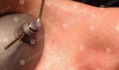 Procedure laser in dermatologia estetica  - Foto del prima - Dott. Fabio Chemello CENTRO MEDICO GENESY