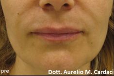 Dott. Aurelio M. Cardaci - Impianto Permalip 60x5 labbro sup e 55x5 labbro inf.
Post 3 mesi. Si noti la morbidezza della protesi nella mimica.