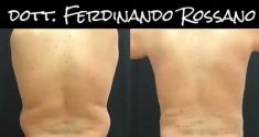 Liposuzione - Foto del prima - Dott. Ferdinando Rossano