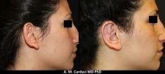 Operazione orecchie (Otoplastica) - Foto del prima - Dott. Aurelio M. Cardaci