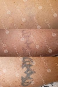 Rimozione tatuaggi - laser - Foto del prima - Dott. Fabio Chemello CENTRO MEDICO GENESY