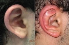 Operazione orecchie (Otoplastica) - Foto del prima - Dott. Salvatore Scandura M.D.