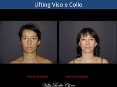 Lifting viso - Foto del prima - Dott.ssa Chiara Botti