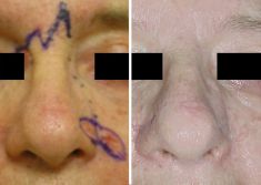 Rinoplastica secondaria - Ricostruzione del naso a seguito di asportazione di 3 tumori della pelle
