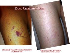 Eliminare capillari e teleangectasie con laser - Foto del prima - Dott. Alvise Cavallini MD, PhD