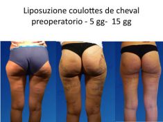 Liposuzione - Foto del prima - Dr. Luigi Maria Lapalorcia Specialista in Chirurgia Plastica Ricostruttiva ed Estetica