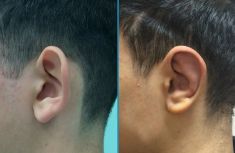 Operazione orecchie (Otoplastica) - Foto del prima - Dott.ssa Moio Mariagrazia