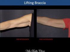 Lifting delle braccia - Foto del prima - Dott.ssa Chiara Botti