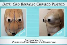 Addominoplastica - Foto del prima - Dott. Ciro Borriello