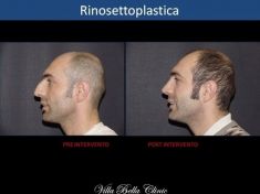 Rinoplastica - Foto del prima - Dott.ssa Chiara Botti