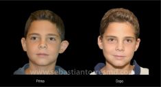 Operazione orecchie (Otoplastica) - Foto del prima - Dott. Sebastian Torres Farr