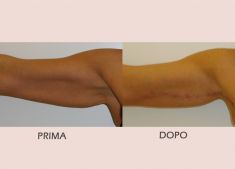 Lifting delle braccia - Foto del prima - Dott. Claudio Cordani