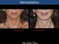 Profiloplastica (Rinoplastica e Mentoplastica) - Foto del prima - Dott.ssa Chiara Botti