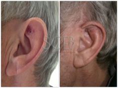 Operazione orecchie (Otoplastica) - Foto del prima - Dott. Manuel De Giovanni