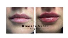 Dott. Umberto Napoli - aumento delle labbra mediante filler Allergan Volbella