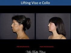 Lifting viso - Foto del prima - Dott.ssa Chiara Botti