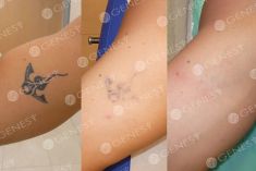 Rimozione tatuaggi - laser - Foto del prima - Dott. Fabio Chemello CENTRO MEDICO GENESY
