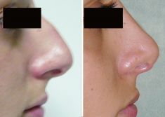 Rinoplastica - Rinoplastica estetica femminile con resezione del gibbo e sollevamento di punta nasale e labbro superiore