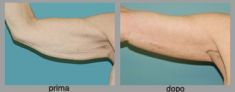 Lifting delle braccia - Foto del prima - Dott. Luca Leva Chirurgo Plastico